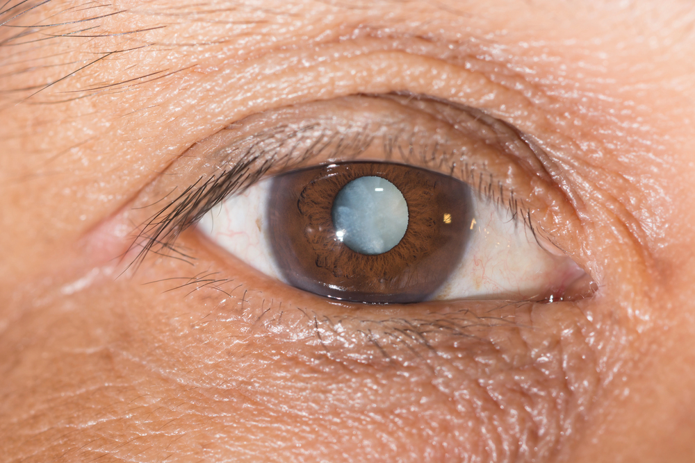 Close-up of eye showing cataract clouding of the lens